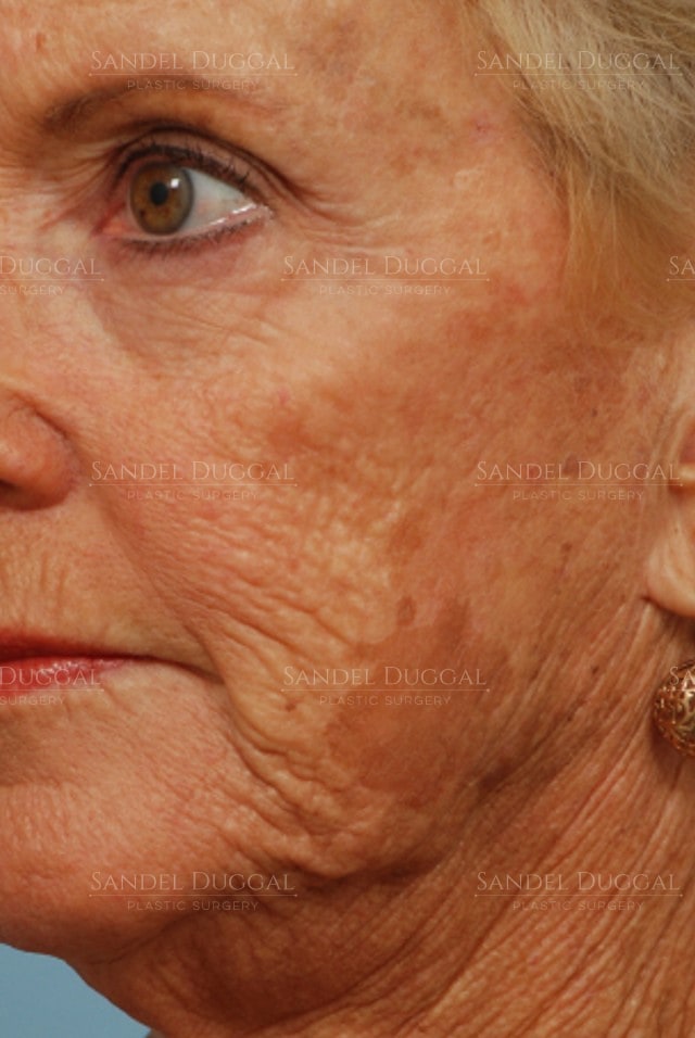 CO2 laser resurfacing before, three-quarter view — patient of Dr. Sandel
