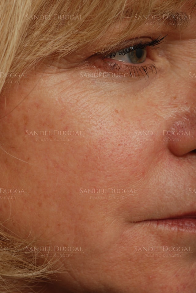 CO2 laser resurfacing for sun damage and pigmentation, after, three-quarter view — patient of Dr. Sandel