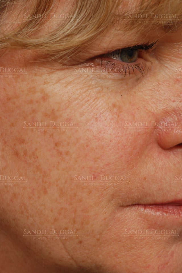 CO2 laser resurfacing for sun damage and pigmentation, before, three-quarter view — patient of Dr. Sandel