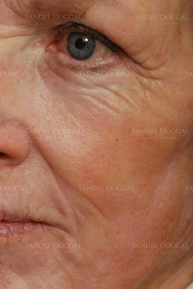 CO2 laser resurfacing for deep lines around the mouth and eyes, after, three-quarter view — patient of Dr. Sandel