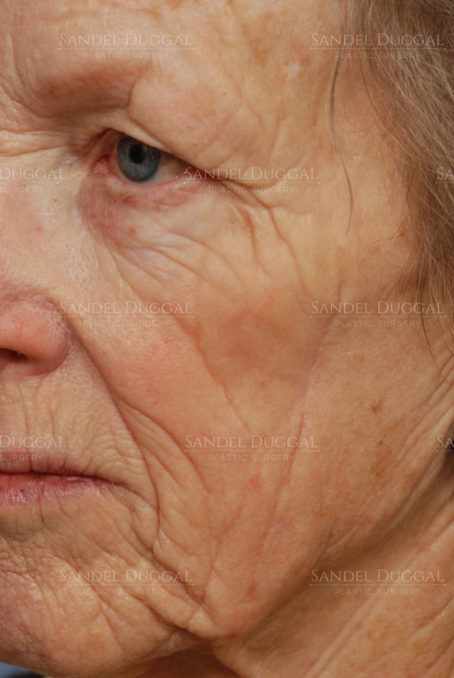 CO2 laser resurfacing for deep lines around the mouth and eyes, before, three-quarter view — patient of Dr. Sandel