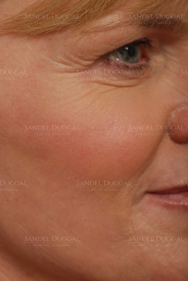 CO2 laser resurfacing for crow's feet and cheek texture, after, three-quarter view — patient of Dr. Sandel
