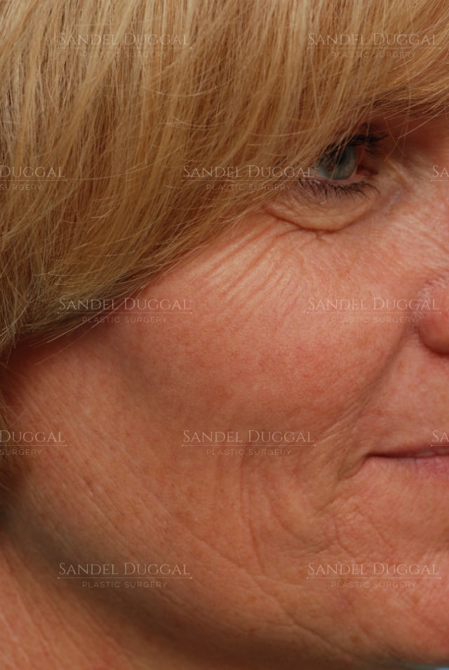 CO2 laser resurfacing for crow's feet and cheek texture, before, three-quarter view — patient of Dr. Sandel