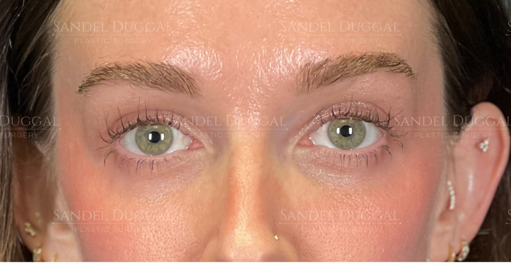 Upper and lower eyelid surgery after, front view — patient of Dr. Sandel