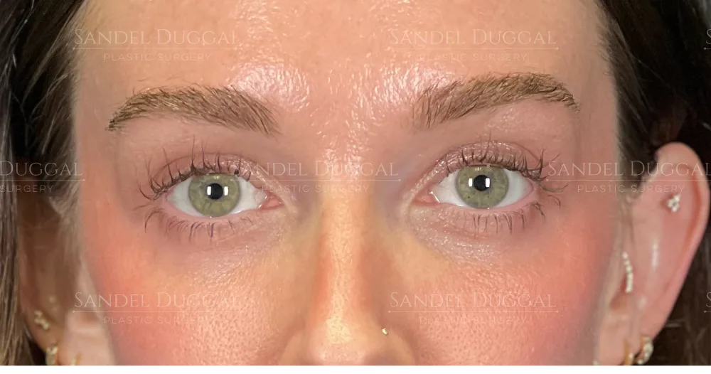 Upper and lower eyelid surgery after, front view — patient of Dr. Sandel