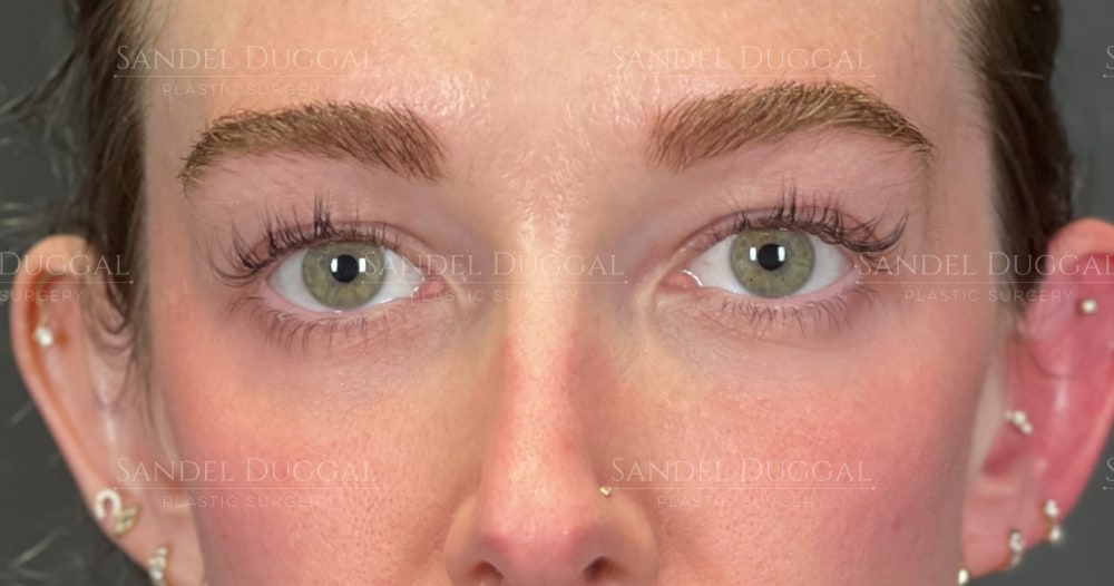 Upper and lower eyelid surgery before, front view — patient of Dr. Sandel