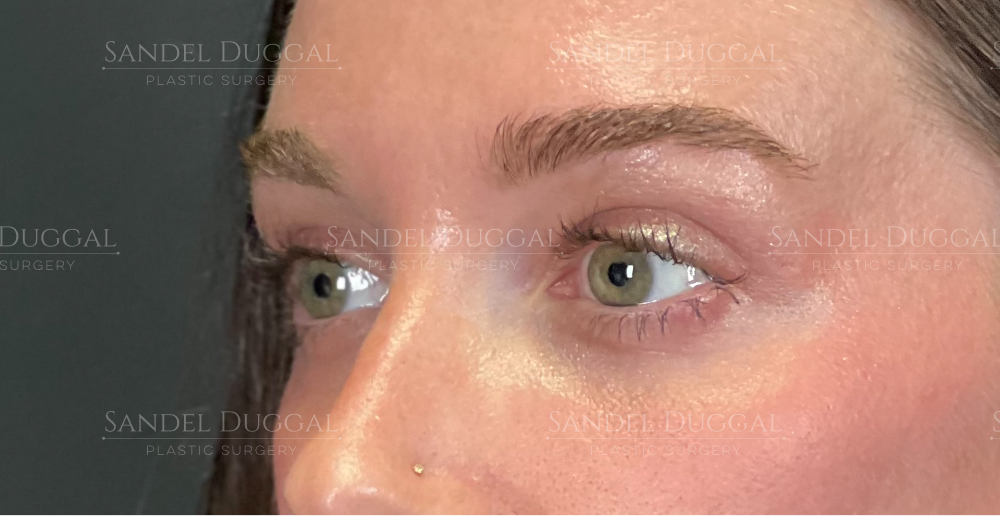 Upper and lower eyelid surgery after, three-quarter view — patient of Dr. Sandel