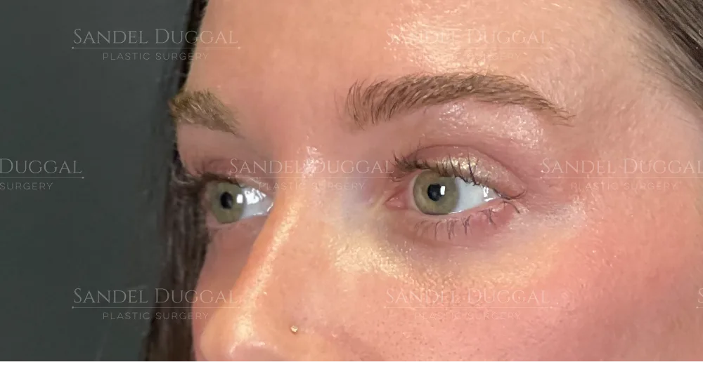 Upper and lower eyelid surgery after, three-quarter view — patient of Dr. Sandel