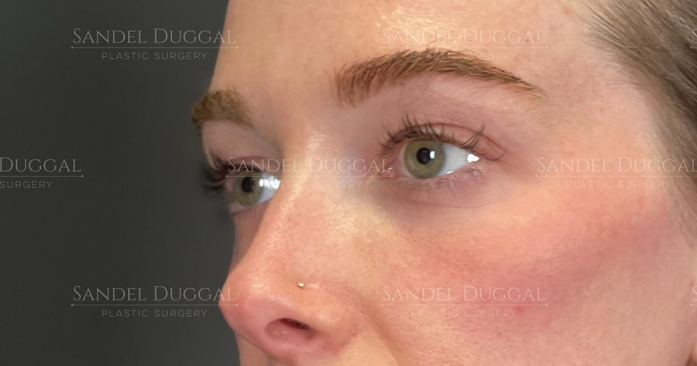 Upper and lower eyelid surgery before, three-quarter view — patient of Dr. Sandel