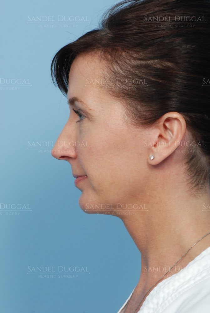 Facelift with chin implant, pre-jowl implant and upper eyelid surgery, after, side view — patient of Dr. Sandel