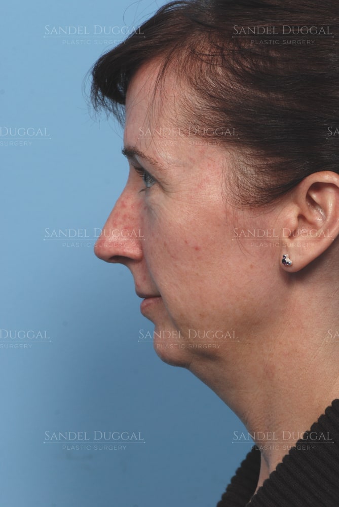 Facelift with chin implant, pre-jowl implant and upper eyelid surgery, before, side view — patient of Dr. Sandel