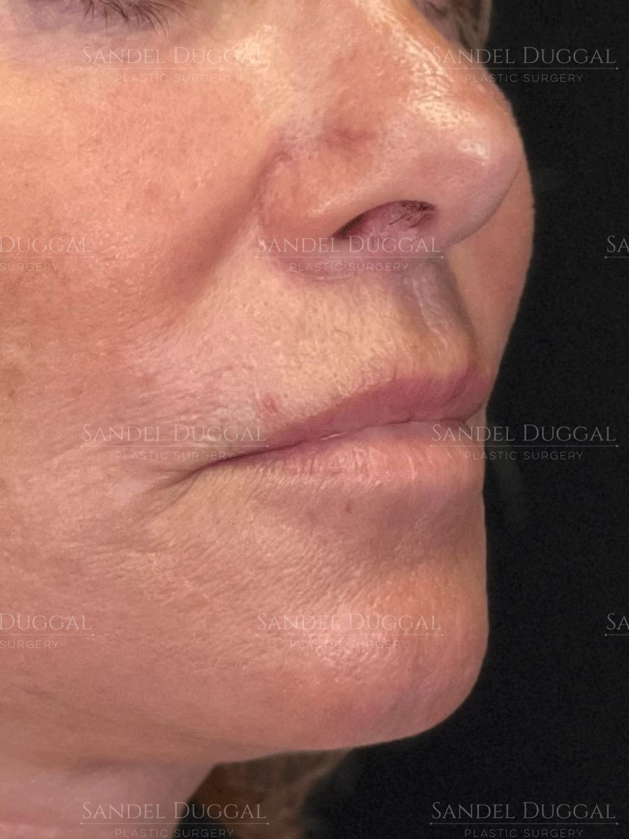 Subnasal lip lift after, three-quarter view — patient of Dr. Sandel