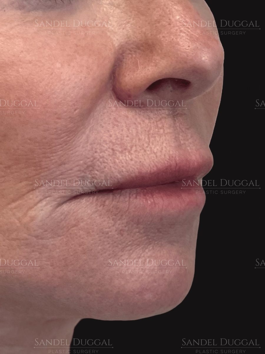 Subnasal lip lift before, three-quarter view — patient of Dr. Sandel
