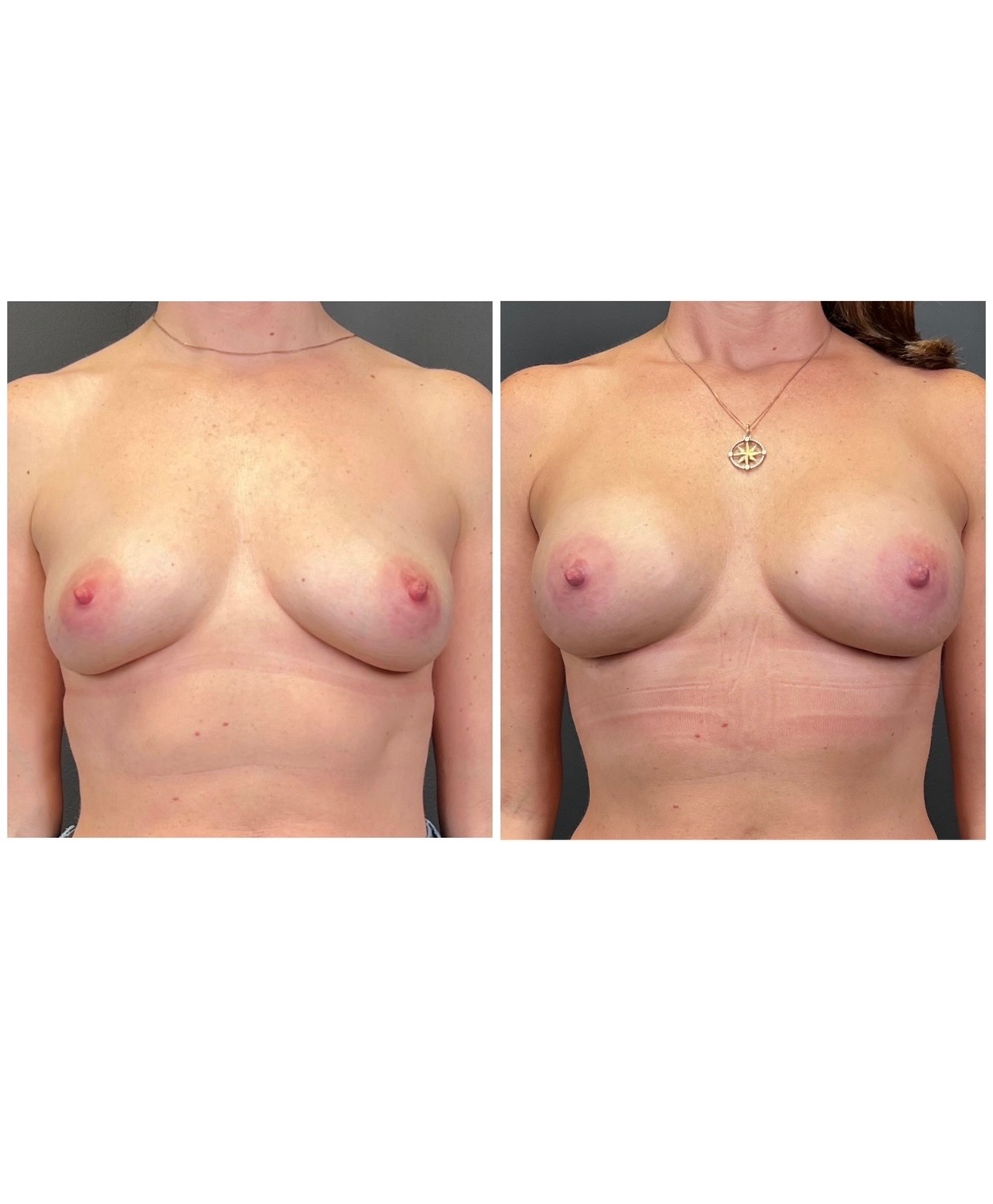 Breast augmentation with Motiva Preserve implants, before and after, front view — patient of Dr. Duggal