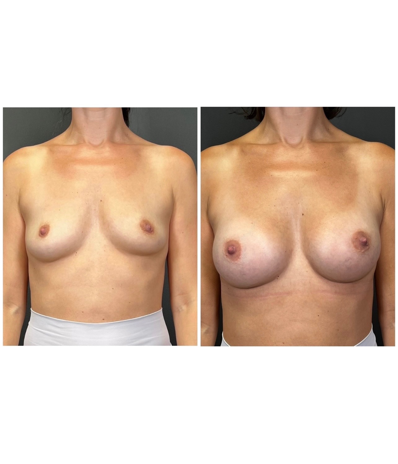 Breast augmentation with Motiva Preserve implants, before and after, front view — patient of Dr. Duggal