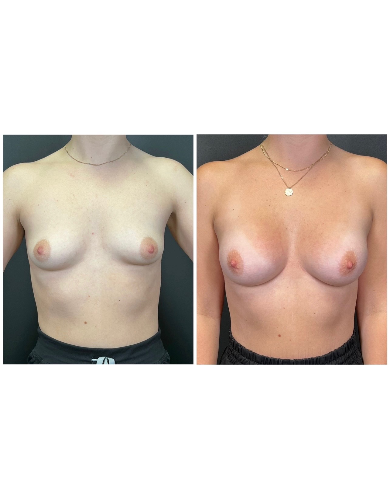 Breast augmentation with Motiva Preserve implants, before and after, front view — patient of Dr. Duggal