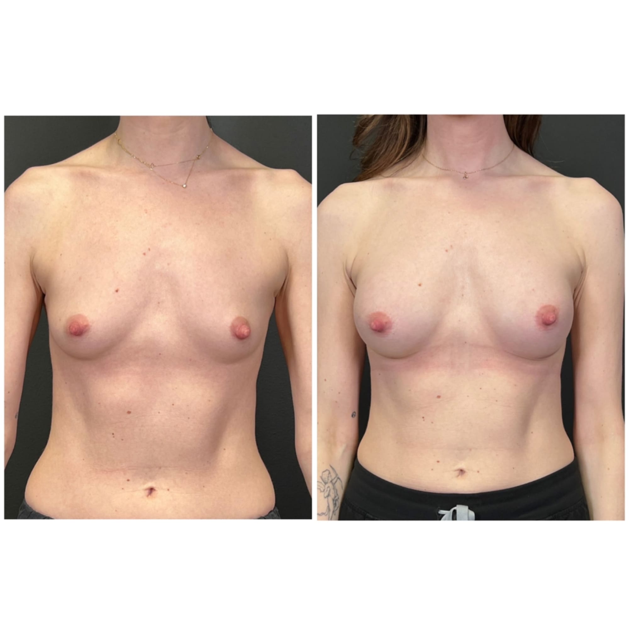 Breast augmentation with Motiva Preserve implants, before and after, front view — patient of Dr. Duggal