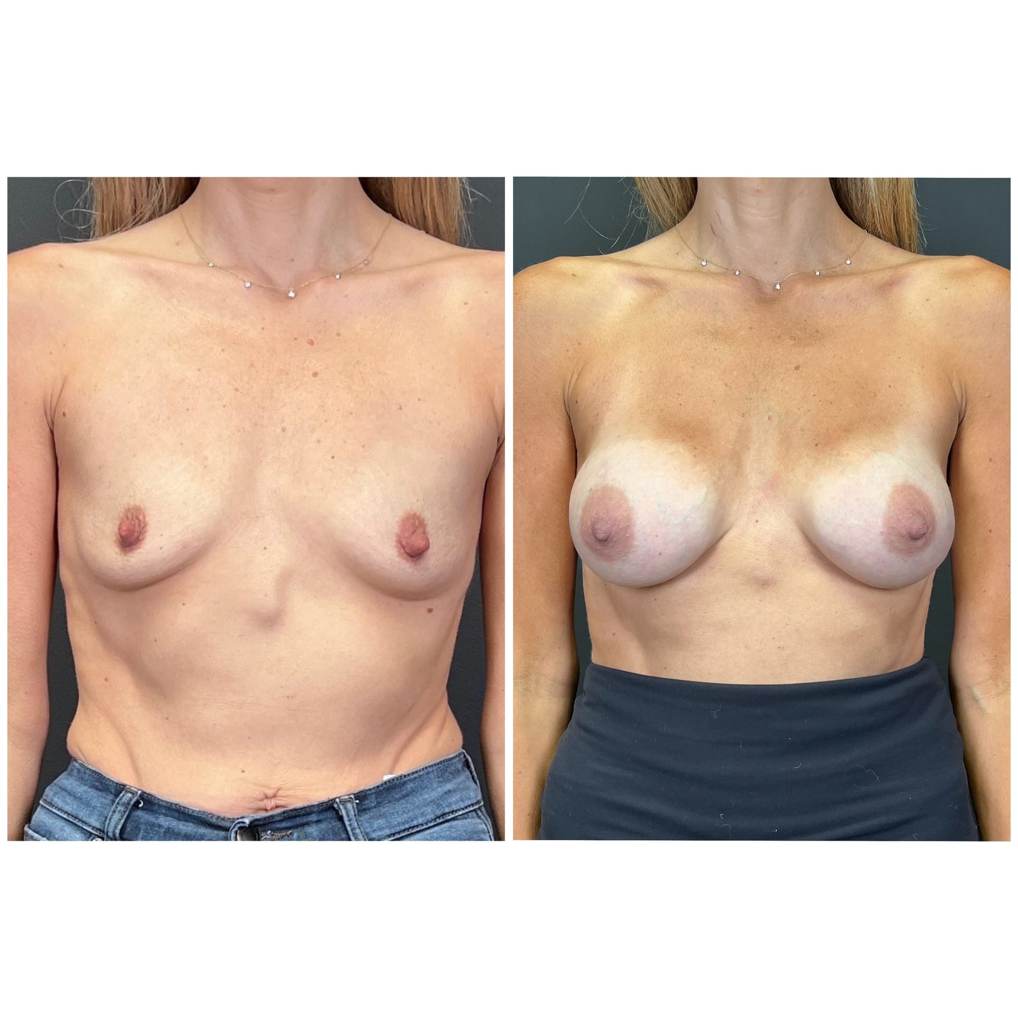 Breast augmentation with Motiva Preserve implants, before and after, front view — patient of Dr. Duggal