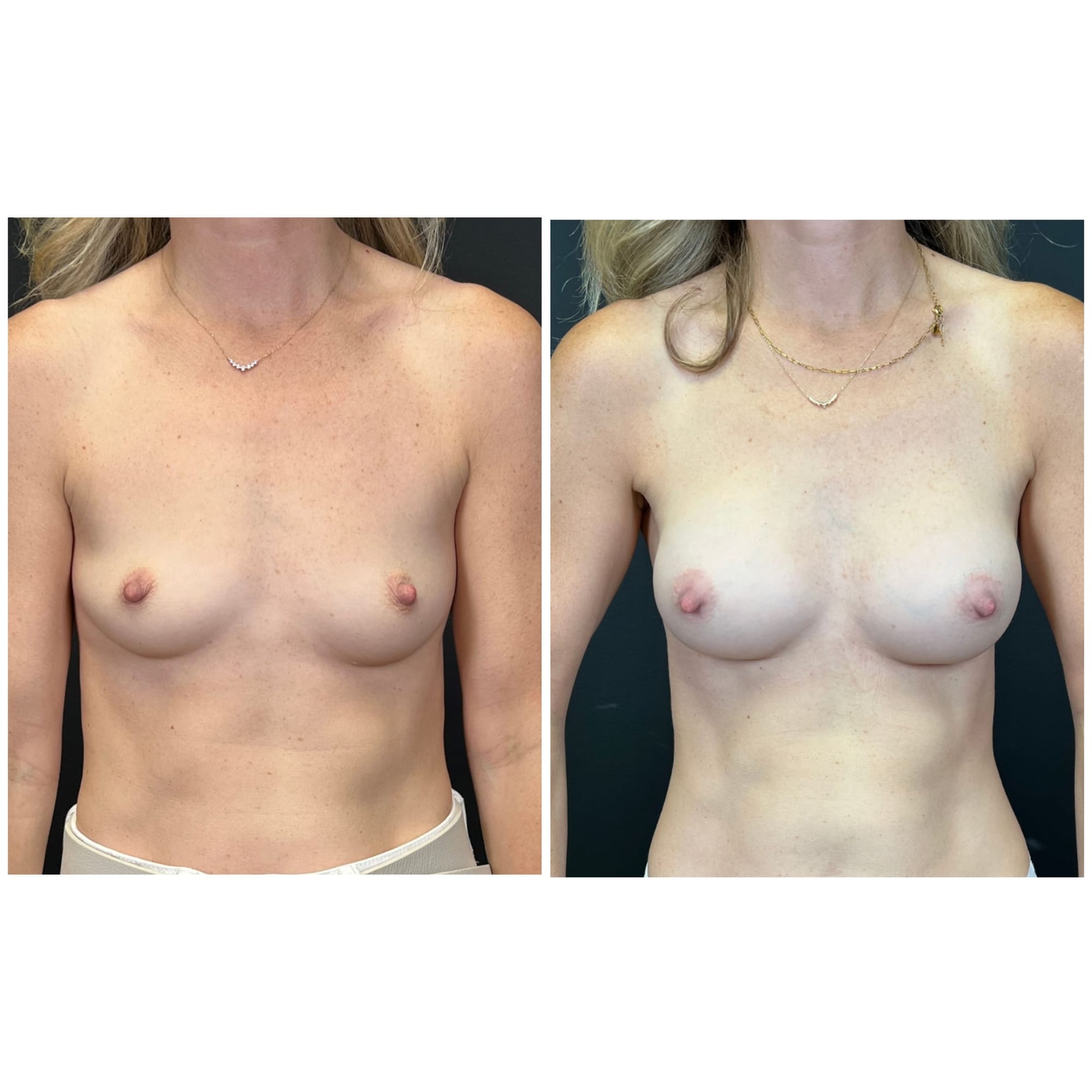Breast augmentation with Motiva Preserve implants, before and after, front view — patient of Dr. Duggal