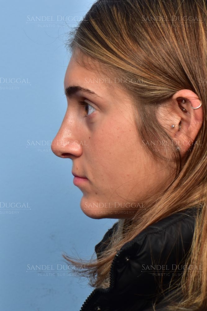 Rhinoplasty after, profile view — patient of Dr. Sandel