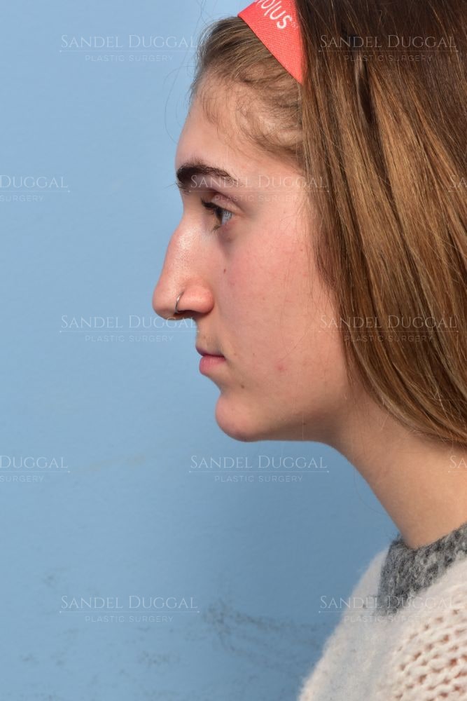 Rhinoplasty before, profile view — patient of Dr. Sandel