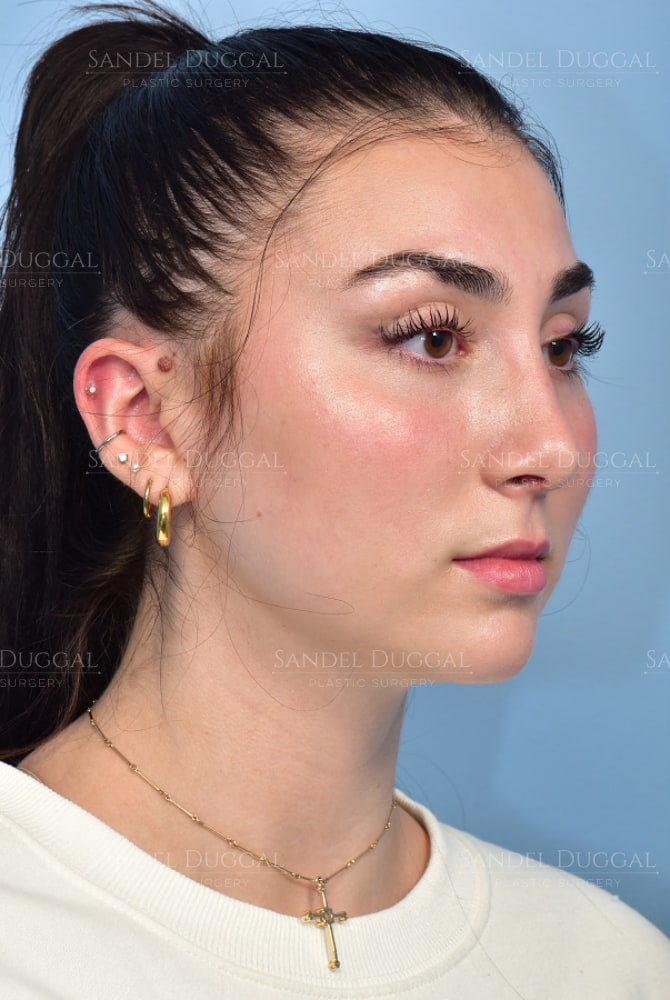 Rhinoplasty after, three-quarter view — patient of Dr. Sandel