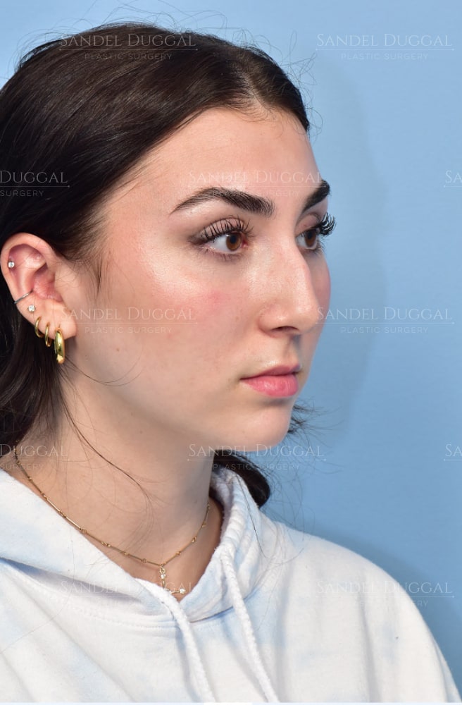 Rhinoplasty before, three-quarter view — patient of Dr. Sandel