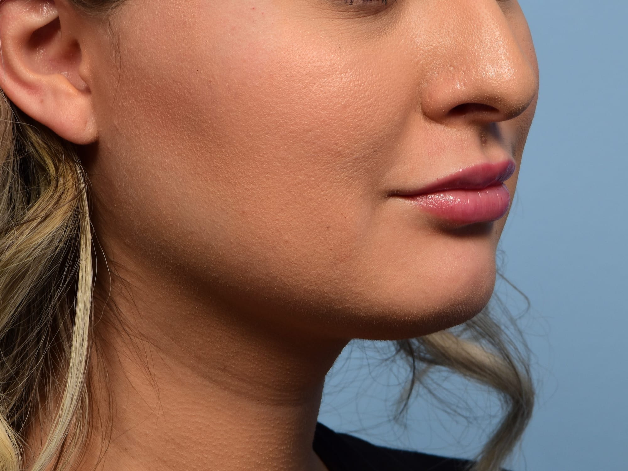 Buccal fat reduction before, three-quarter view