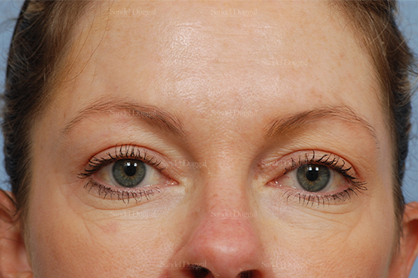 botox / fillers patient