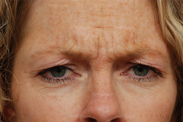 botox / fillers patient
