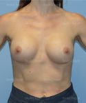 breast augmentation patient