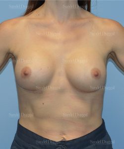 breast augmentation patient