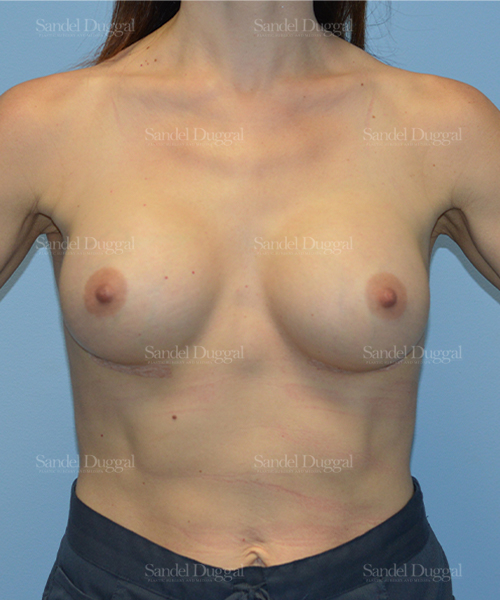 breast augmentation patient