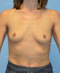 breast augmentation patient