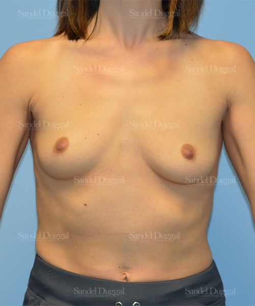 breast augmentation patient