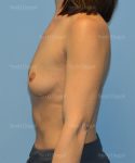 breast augmentation patient