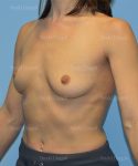 breast augmentation patient