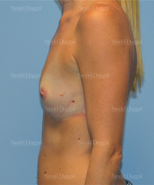 breast augmentation patient