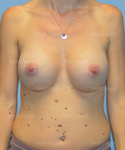 breast augmentation patient