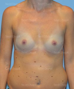 breast augmentation patient