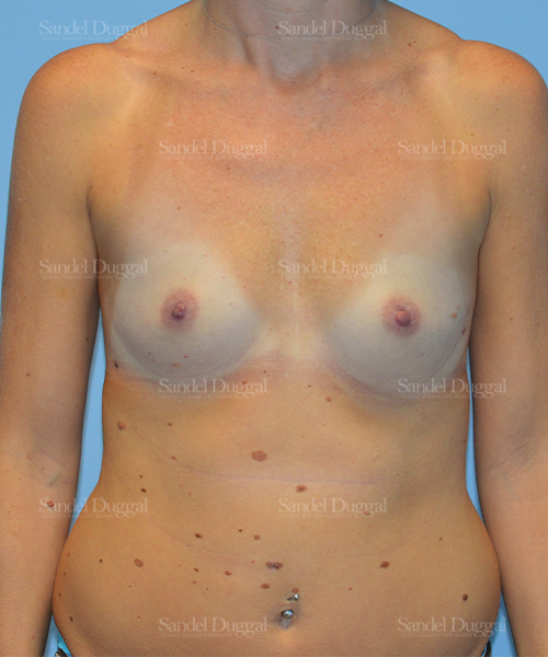 breast augmentation patient