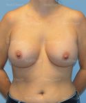 breast augmentation patient