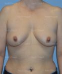 breast augmentation patient