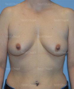 breast augmentation patient