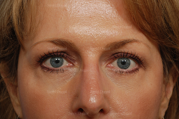 eyelid rejuvenation patient