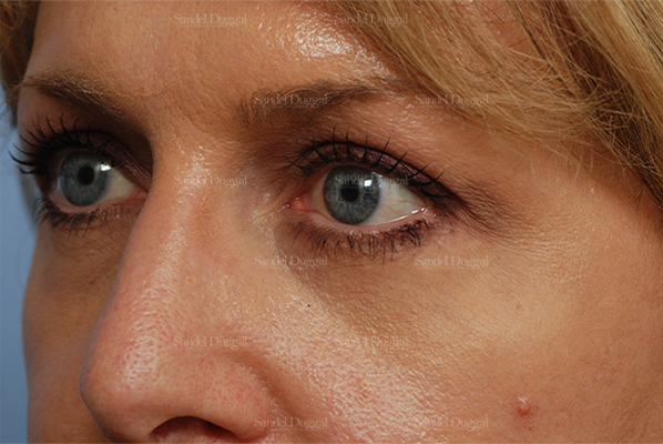 eyelid rejuvenation patient