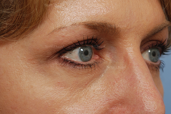 eyelid rejuvenation patient