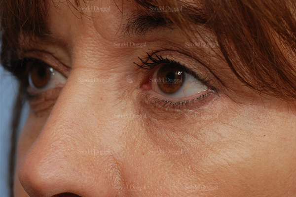 eyelid rejuvenation patient