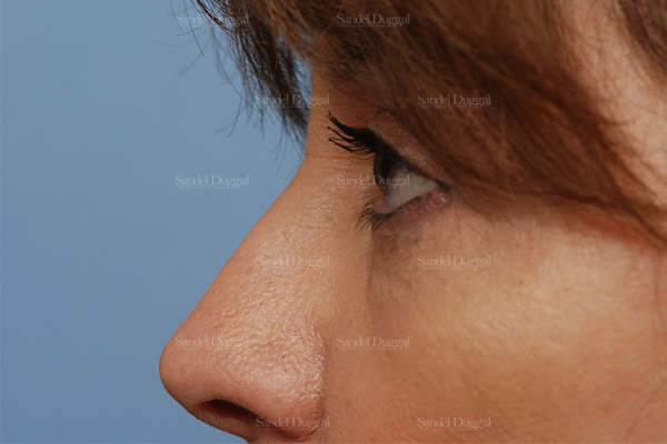 eyelid rejuvenation patient