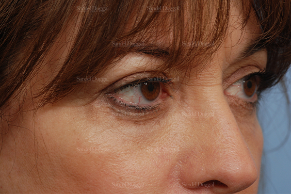 eyelid rejuvenation patient